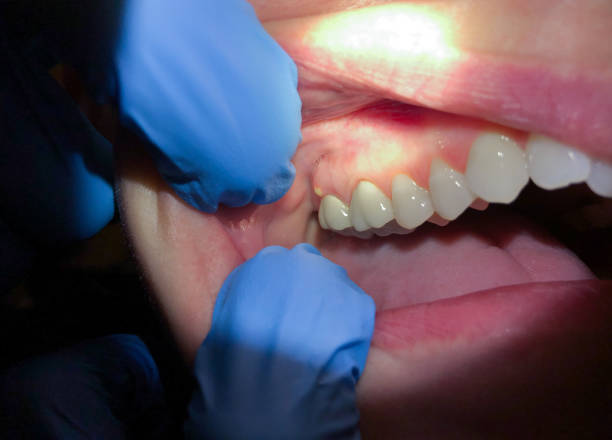 Best Tooth Infection Emergency Dentist  in Garnet, CA