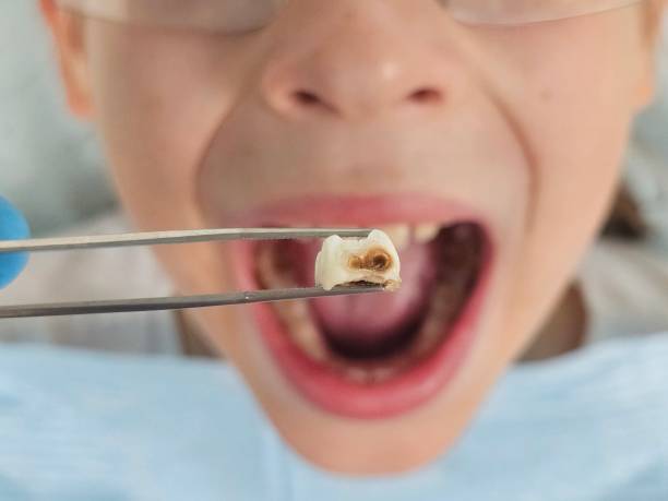 Best Cracked Tooth Emergency Dentist  in Garnet, CA